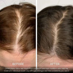 BioDensity+ | Hair Microinfusion System