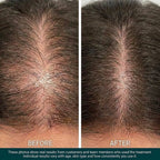 BioDensity+ | Hair Microinfusion System