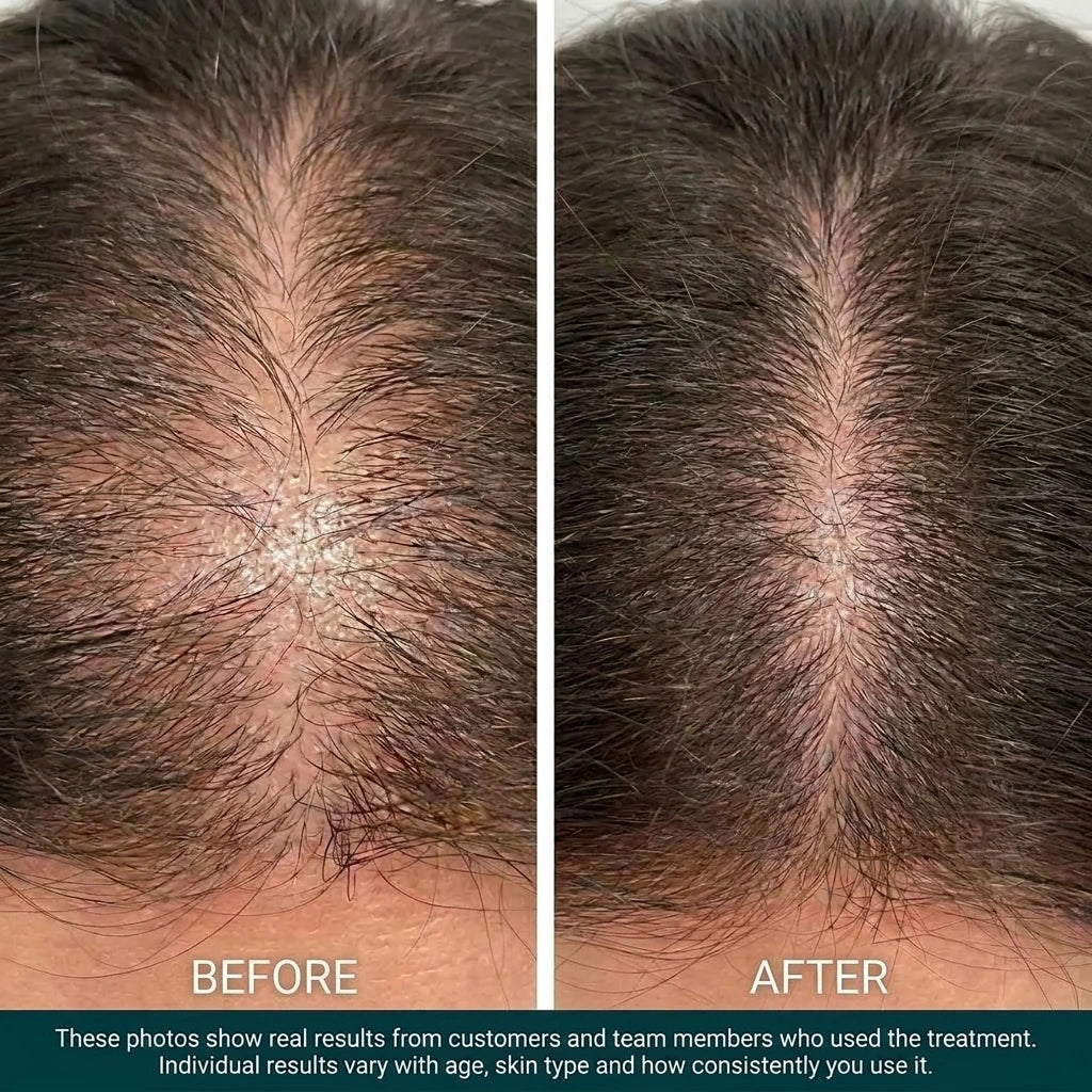 BioDensity+ | Hair Microinfusion System
