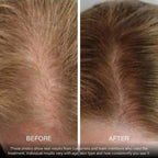 BioDensity+ | Hair Microinfusion System