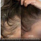 BioDensity+ | Hair Microinfusion System