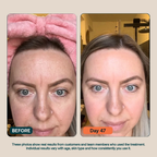 BioInfusion+ | Microinfusion System