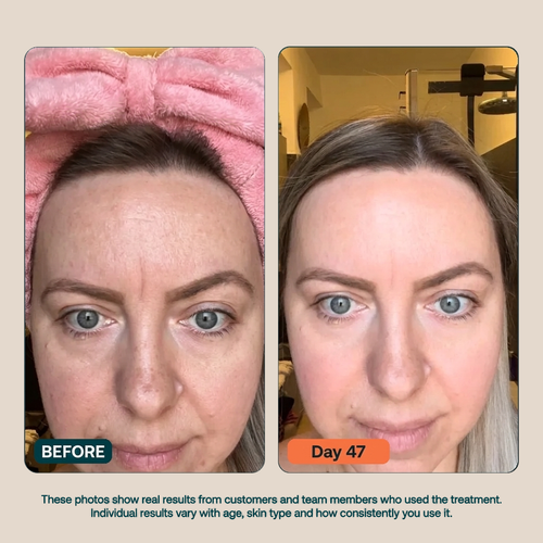 BioInfusion+ | Microinfusion System