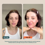 BioInfusion+ | Microinfusion System