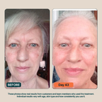 BioInfusion+ | Microinfusion System