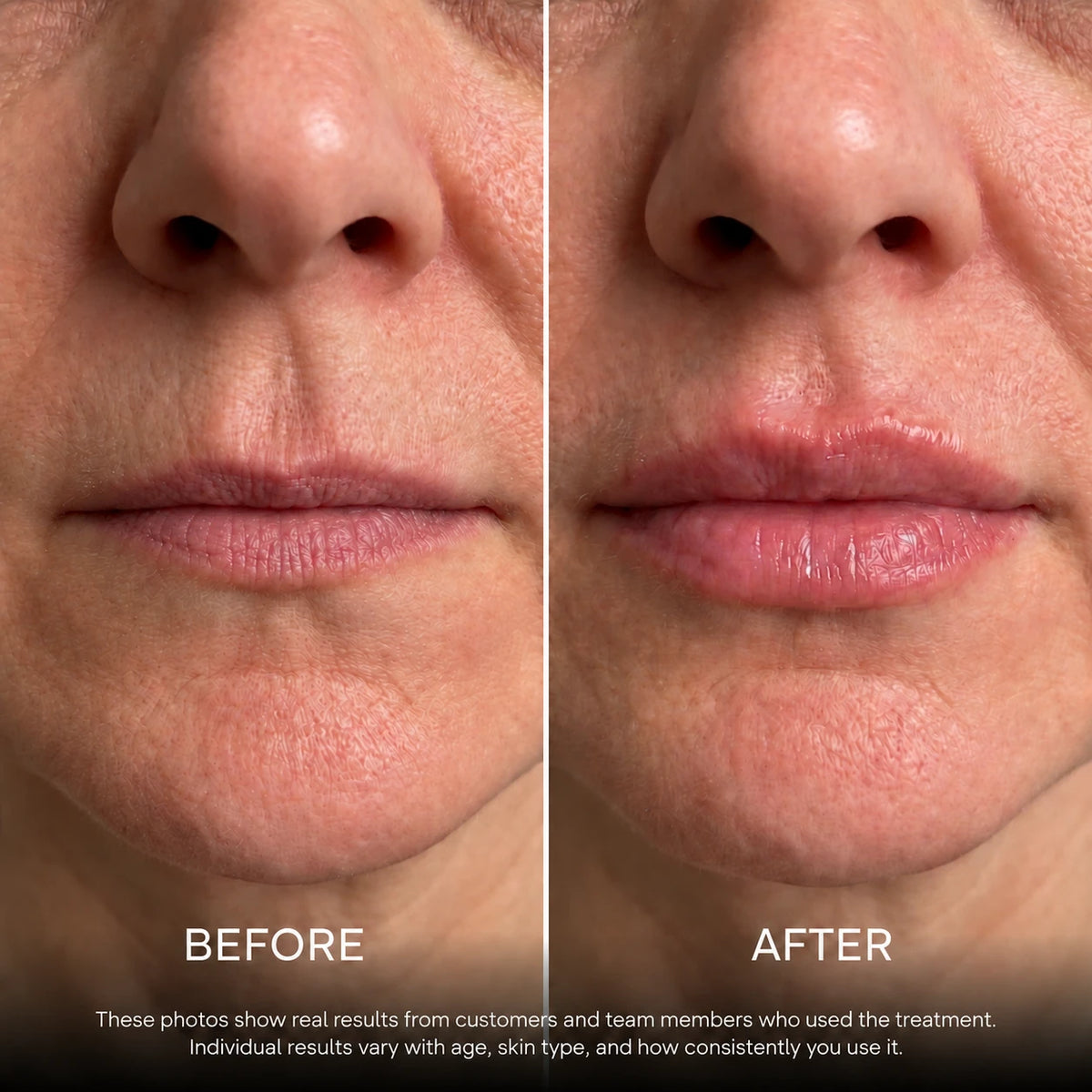 Before and after lips — 3 applications