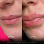 Before and after lips — 2 applications