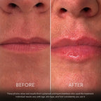 Before and after lips — 3 applications